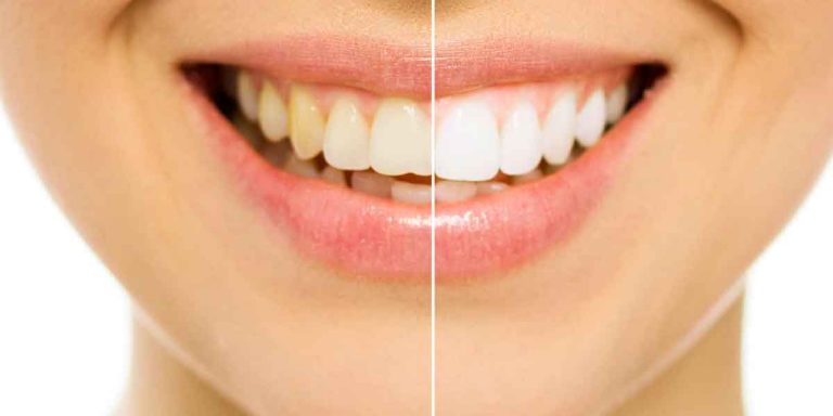 Teeth Whitening Treatment: Whiter Smile in Just One Hour